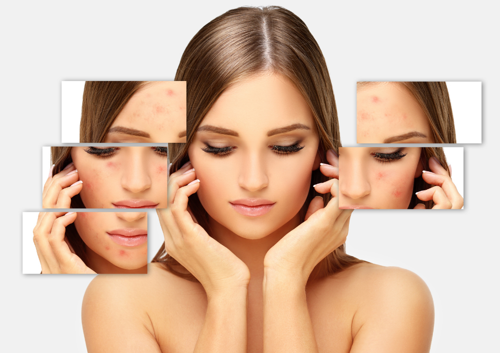 Acne Treatment