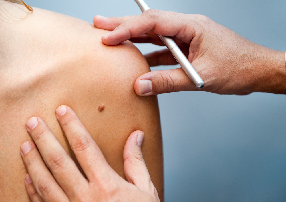 Acne Treatment